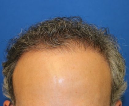 Hair Restoration Before & After Patient #5774