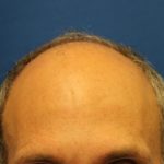 Hair Restoration Before & After Patient #5774