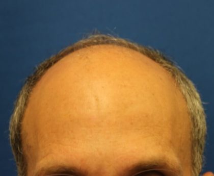 Hair Restoration Before & After Patient #5774