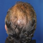 Hair Restoration Before & After Patient #5774