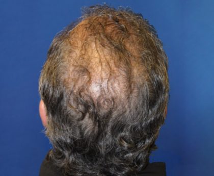 Hair Restoration Before & After Patient #5774