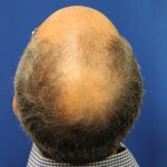 Hair Restoration Before & After Patient #5774