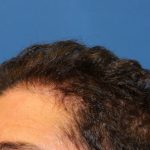 Hair Restoration Before & After Patient #5779