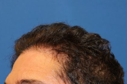 Hair Restoration Before & After Patient #5779