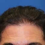 Hair Restoration Before & After Patient #5779