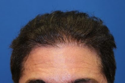 Hair Restoration Before & After Patient #5779