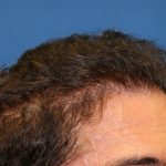 Hair Restoration Before & After Patient #5779