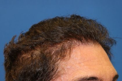 Hair Restoration Before & After Patient #5779