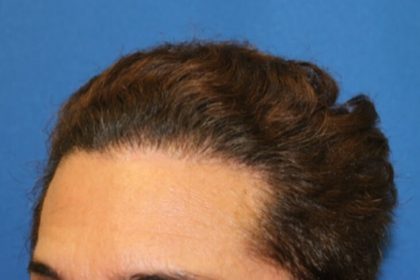 Hair Restoration Before & After Patient #5779