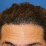 Hair Restoration Before & After Patient #5779