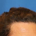 Hair Restoration Before & After Patient #5779