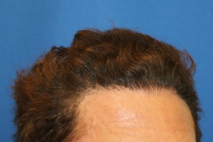 Hair Restoration Before & After Patient #5779