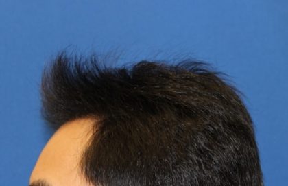 Hair Restoration Before & After Patient #5662