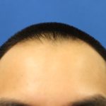 Hair Restoration Before & After Patient #5662