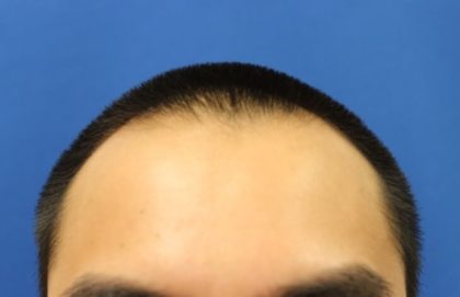 Hair Restoration Before & After Patient #5662