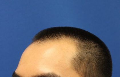 Hair Restoration Before & After Patient #5662