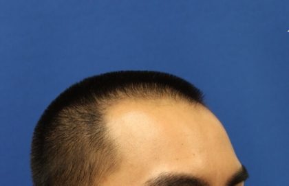 Hair Restoration Before & After Patient #5662