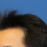 Hair Restoration Before & After Patient #5662