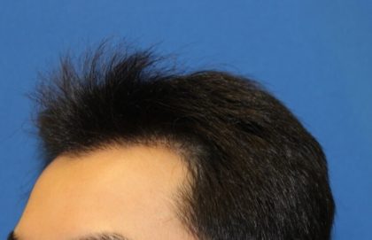 Hair Restoration Before & After Patient #5662