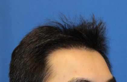 Hair Restoration Before & After Patient #5662