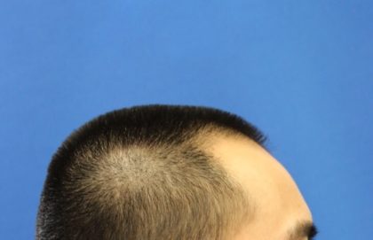 Hair Restoration Before & After Patient #5662