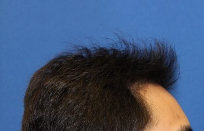 Hair Restoration Before & After Patient #5662