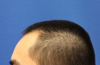 Hair Restoration Before & After Patient #5662