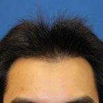 Hair Restoration Before & After Patient #5662