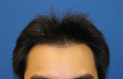 Hair Restoration Before & After Patient #5662