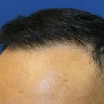 Hair Restoration Before & After Patient #5702