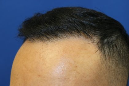 Hair Restoration Before & After Patient #5702