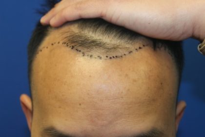 Hair Restoration Before & After Patient #5702