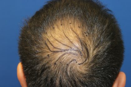 Hair Restoration Before & After Patient #5702