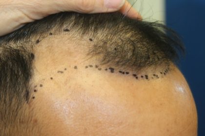 Hair Restoration Before & After Patient #5702