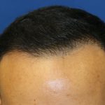 Hair Restoration Before & After Patient #5702