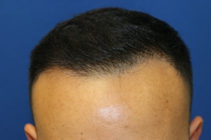 Hair Restoration Before & After Patient #5702