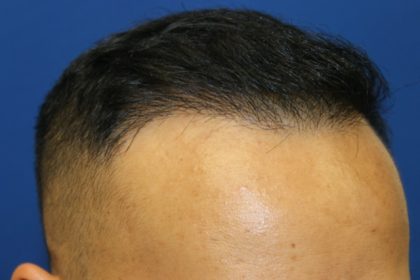 Hair Restoration Before & After Patient #5702