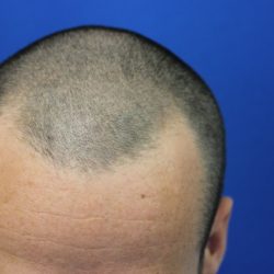 Hair Restoration Before & After Patient #5697