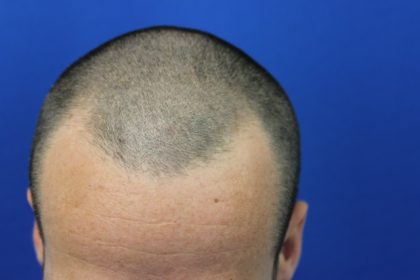 Hair Restoration Before & After Patient #5697