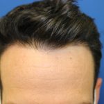 Hair Restoration Before & After Patient #5697