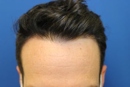 Hair Restoration Before & After Patient #5697