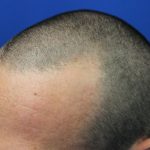 Hair Restoration Before & After Patient #5697