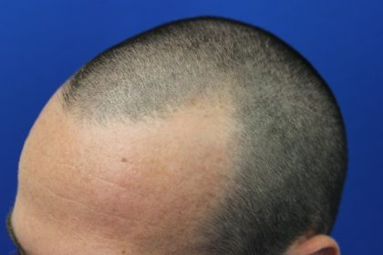 Hair Restoration Before & After Patient #5697
