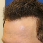 Hair Restoration Before & After Patient #5711