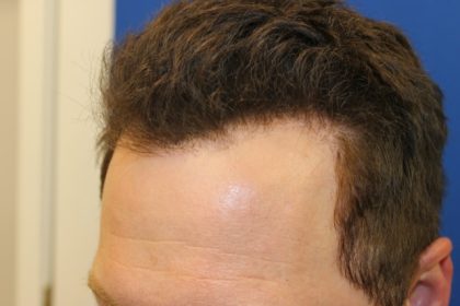 Hair Restoration Before & After Patient #5711