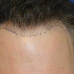 Hair Restoration Before & After Patient #5711