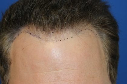 Hair Restoration Before & After Patient #5711