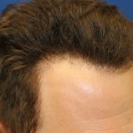 Hair Restoration Before & After Patient #5711