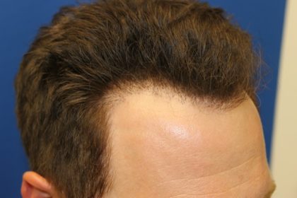 Hair Restoration Before & After Patient #5711