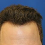 Hair Restoration Before & After Patient #5711